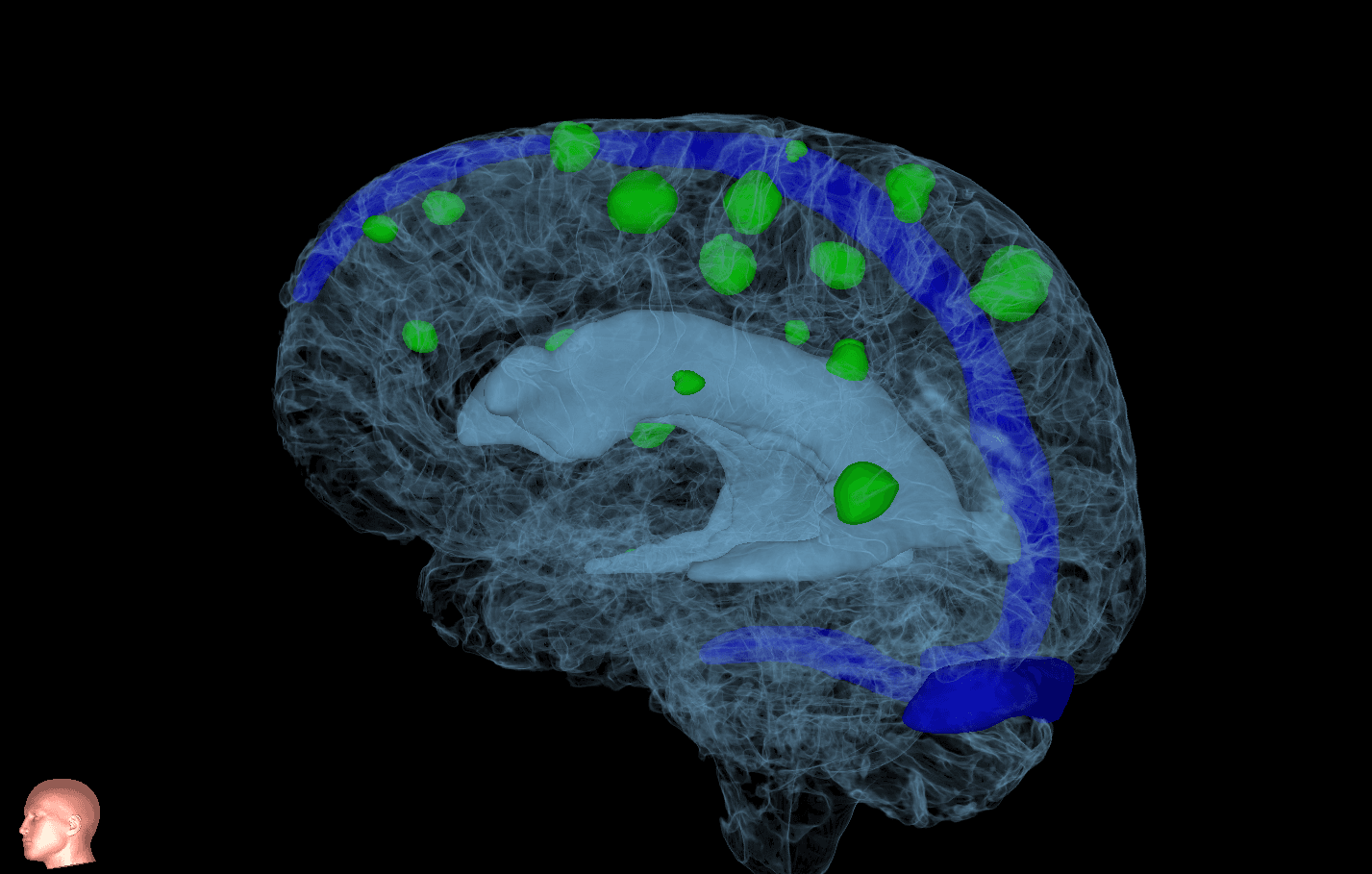 MRI imaging used to evaluate brain metastases