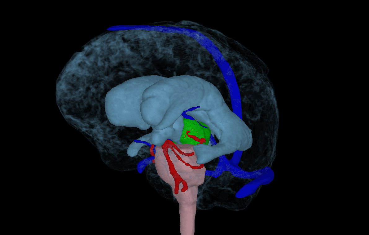 MRI imaging of an ependymoma