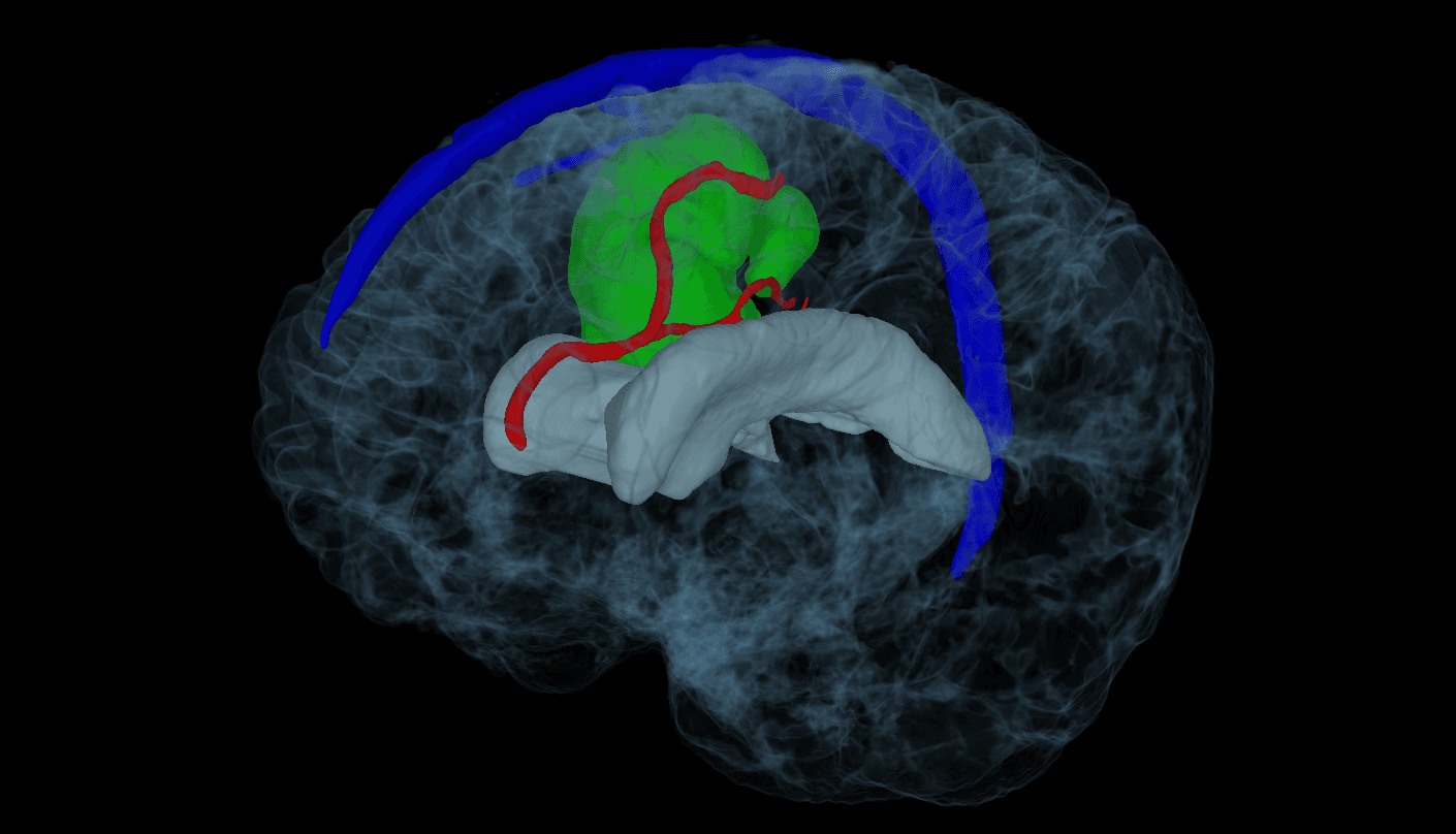 Dr. Sherman reviewing brain imaging during glioblastoma surgery