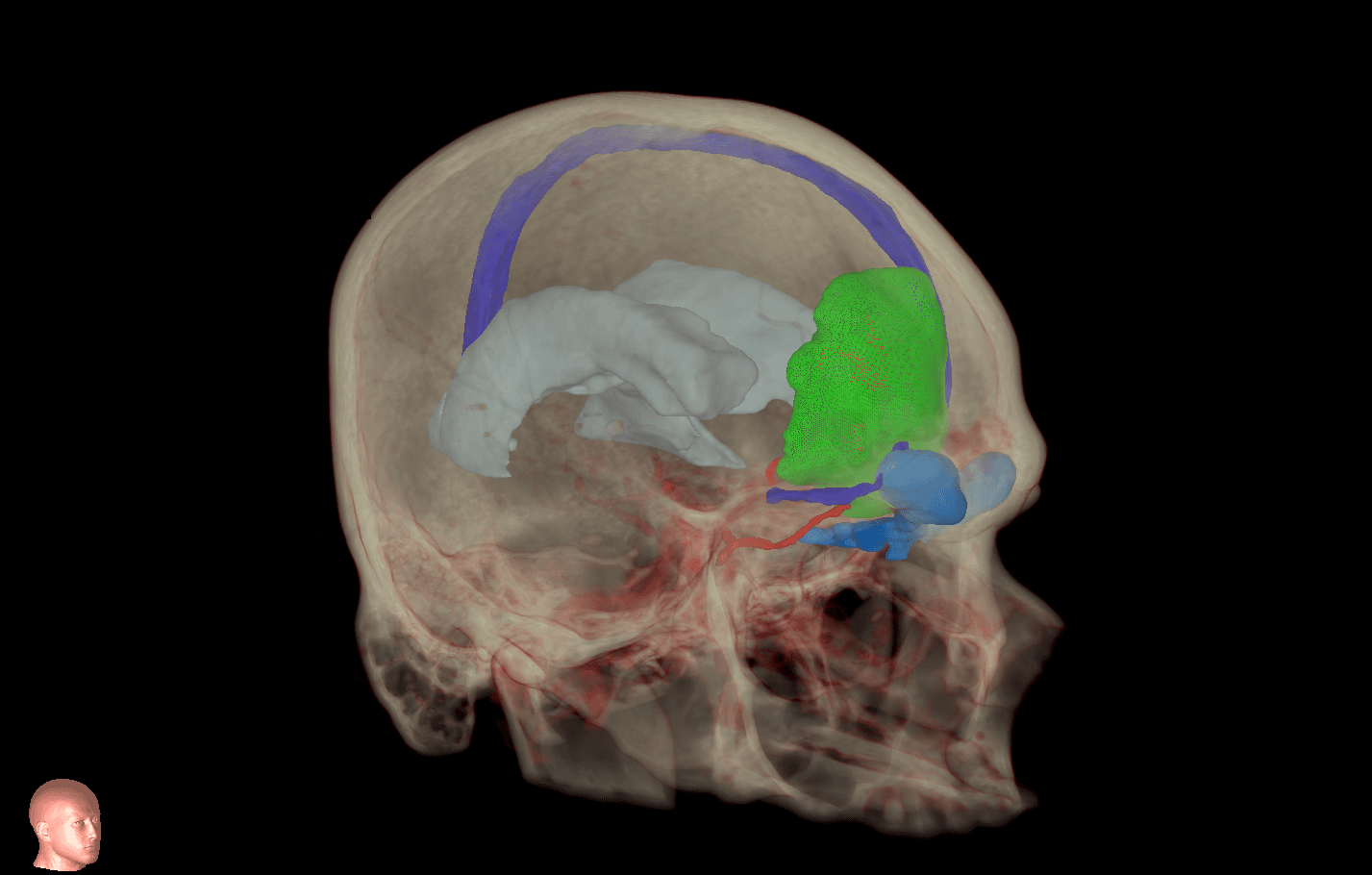 MRI imaging of a meningioma
