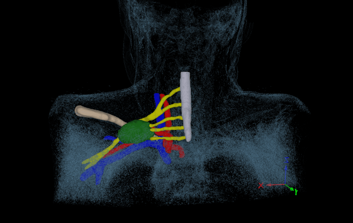 Anatomic illustration of a peripheral nerve tumor