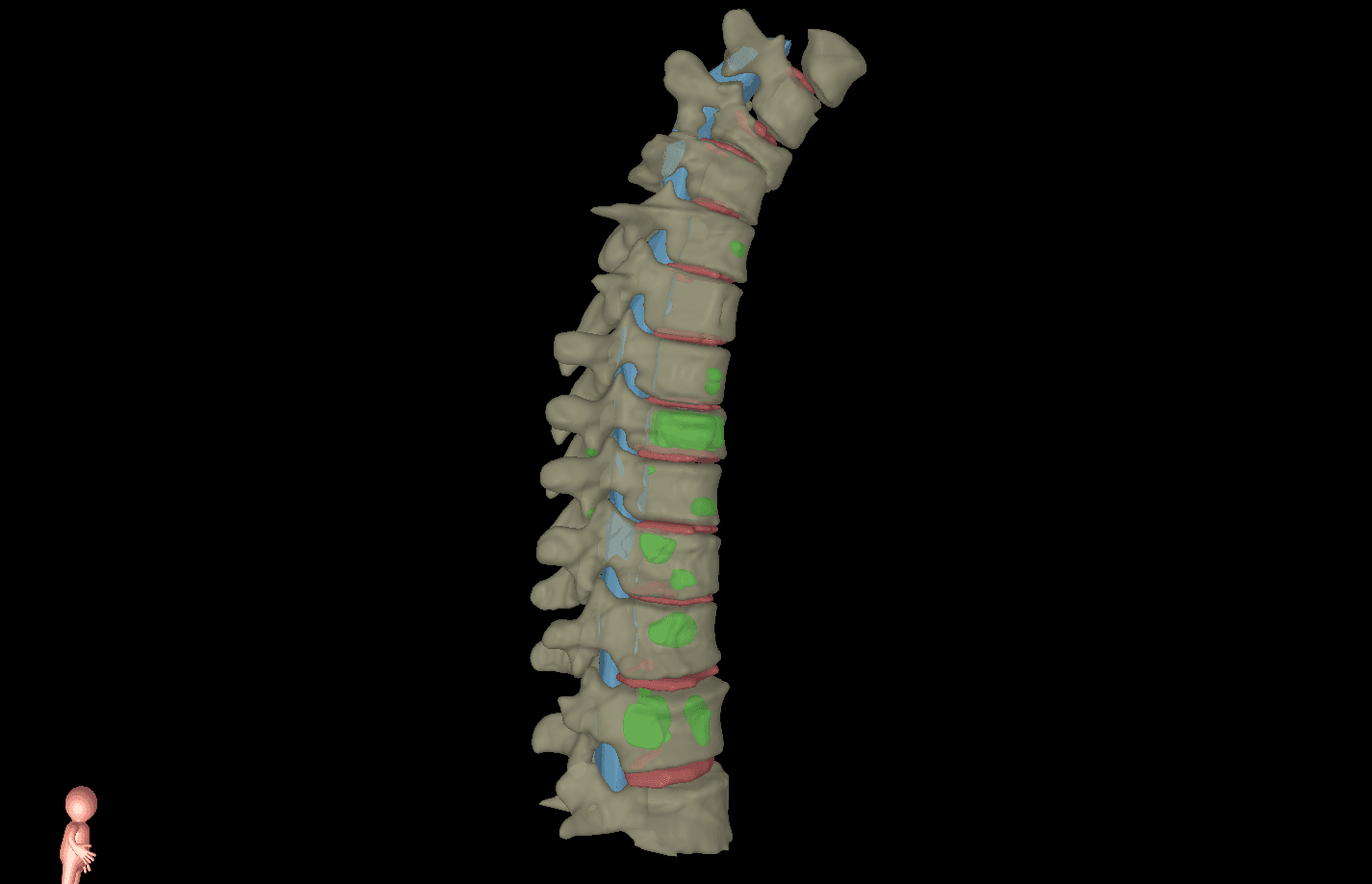 MRI imaging used to evaluate spine metastases