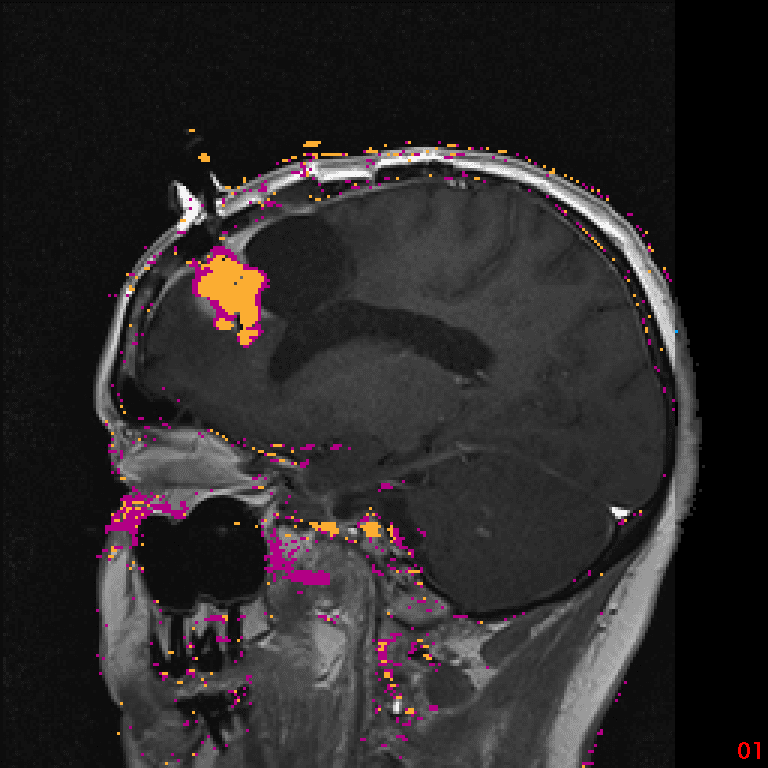 MRI showing a laser ablation plan for a deep brain tumor