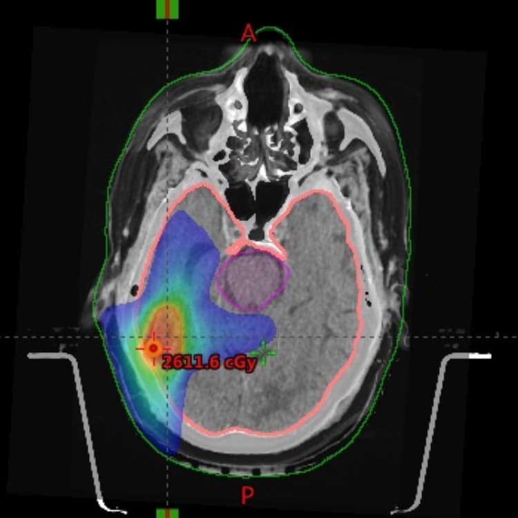 Stereotactic radiosurgery dose plan on patient imaging